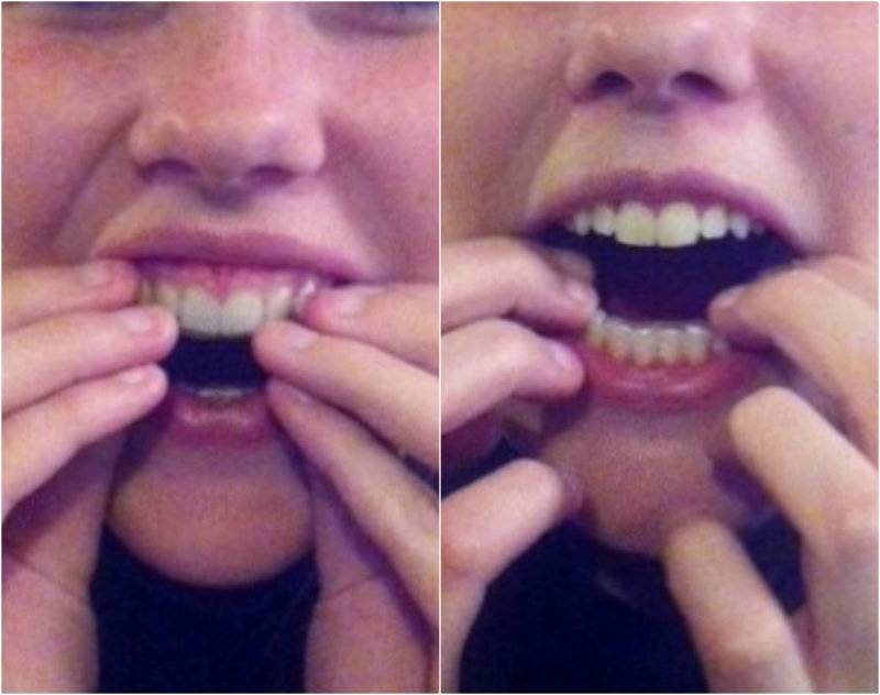 Diy Teeth Whitening Smile Brilliant Review