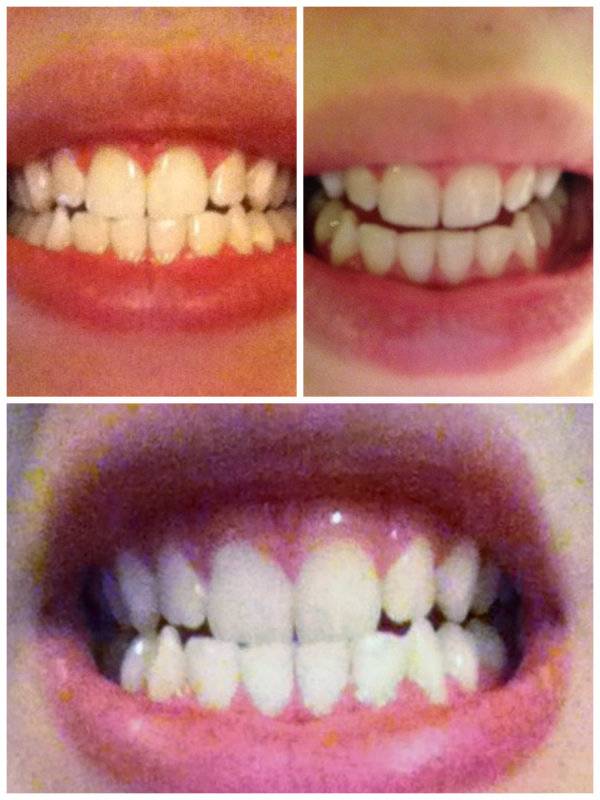 DIY Teeth Whitening: Smile Brilliant Review DIY Teeth Whitening: Smile Brilliant Review